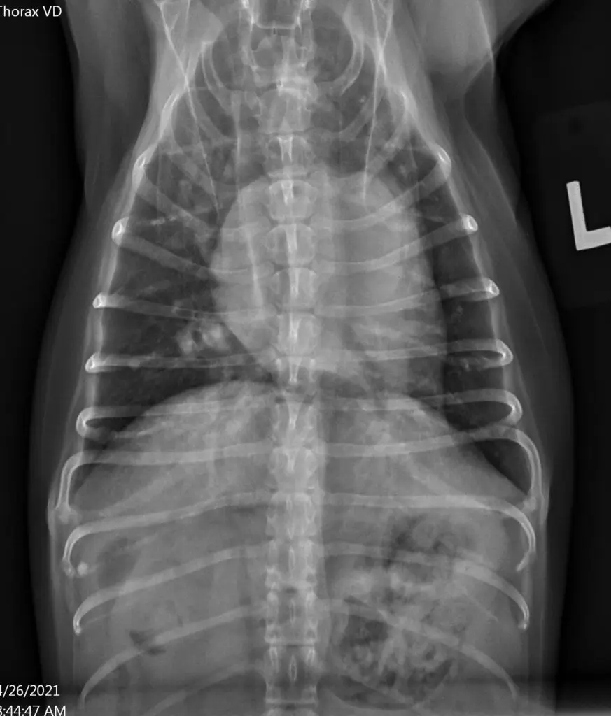 Left atrial enlargement