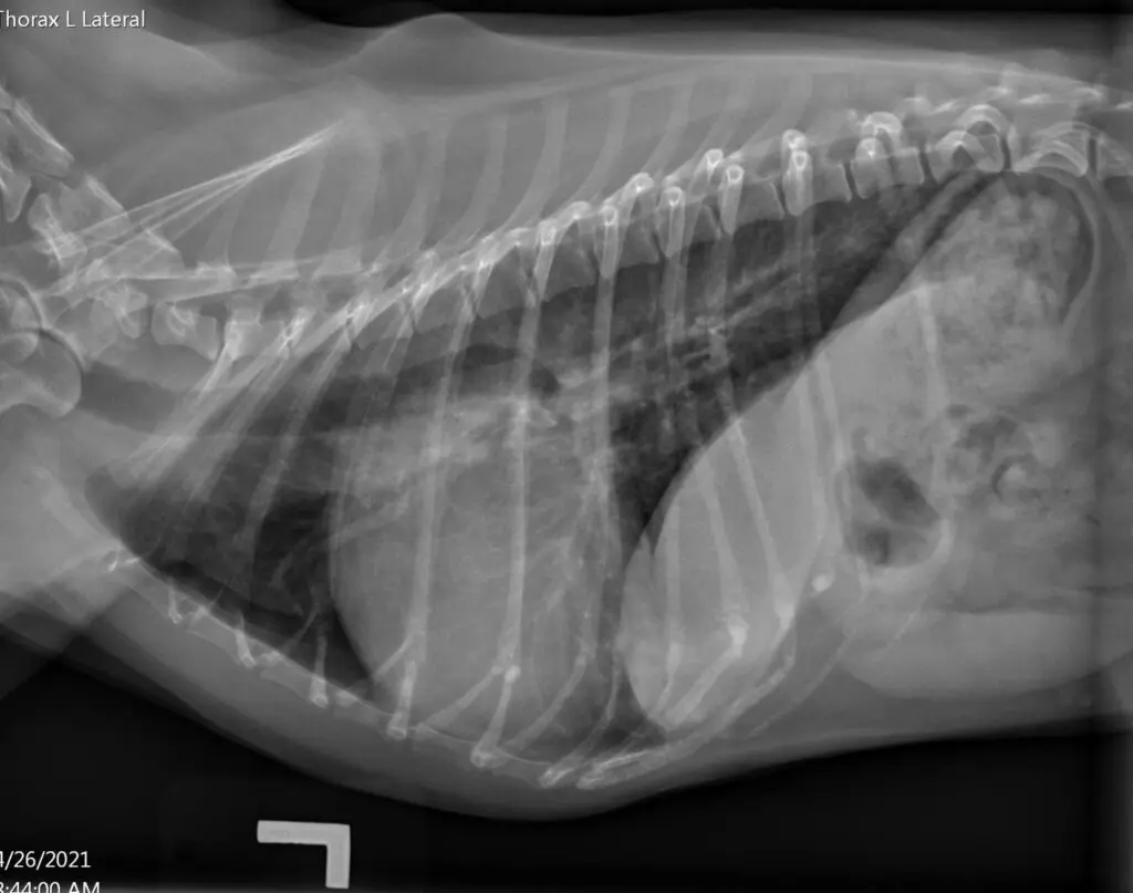 Right sided cardiomegaly