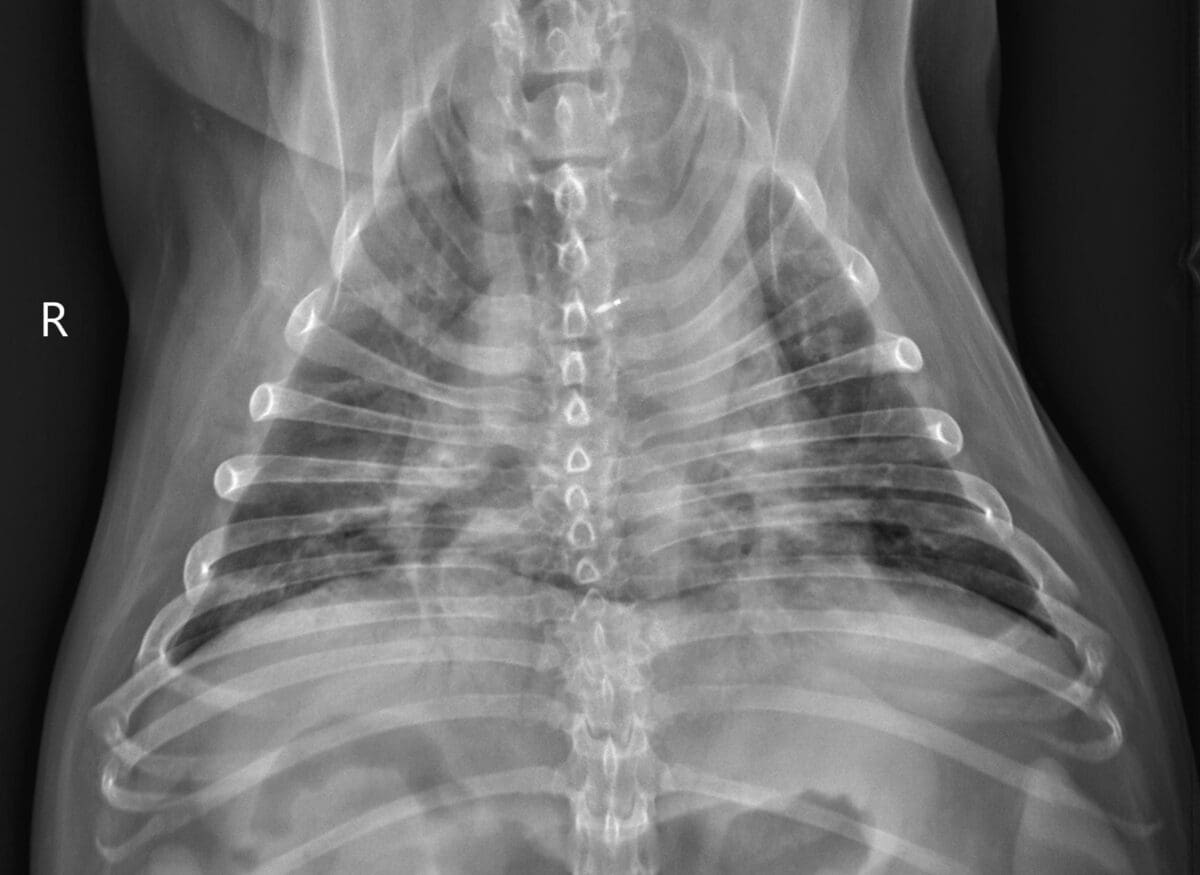 Idiopathic ARDS