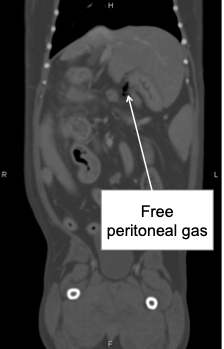 Free Peritoneal Gas