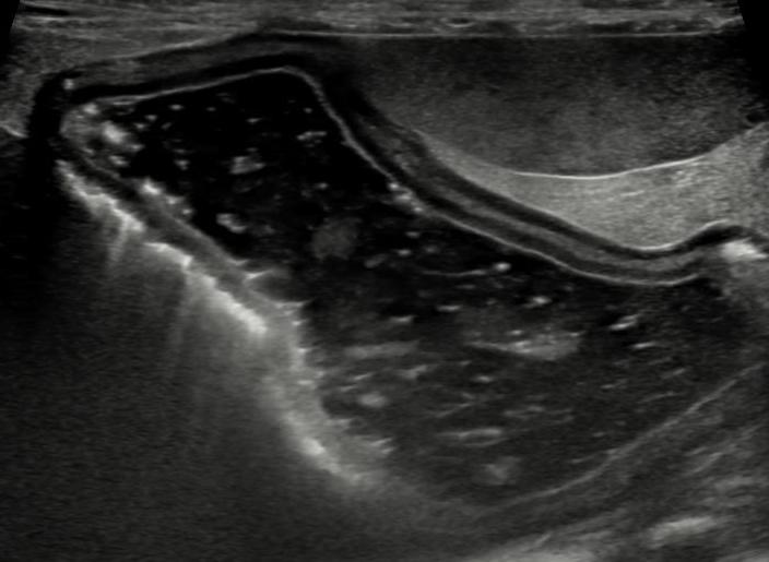 Gas in the gastric wall