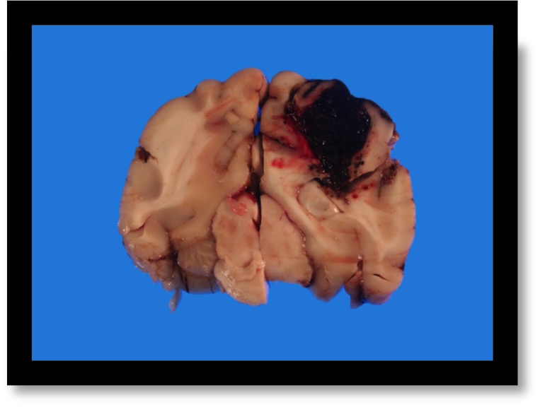 Hyperosmolar therapy in spontaneous intracerebral hemorrhage
