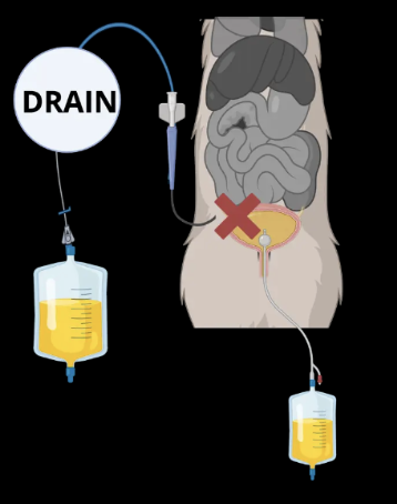 Peritoneal drain and urinary catheter as medical treatment tool for urinary tract rupture